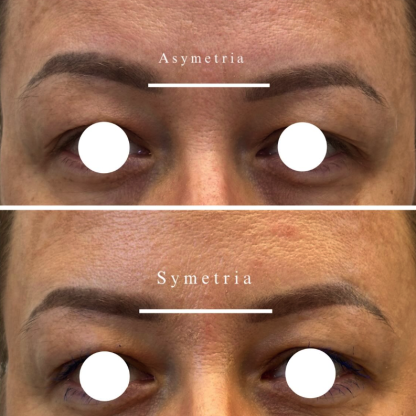 Leczenie nierównoległego ustawienia brwi wtórne do asymetrii czynności skurczowej mięśni