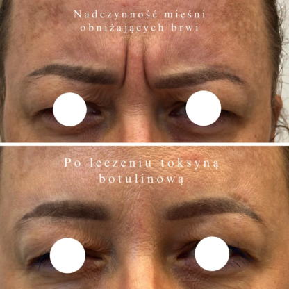 Leczenie nierównoległego ustawienia brwi wtórne do asymetrii czynności skurczowej mięśni
