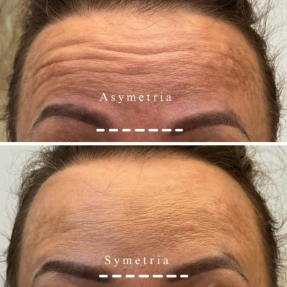 Leczenie nierównoległego ustawienia brwi wtórne do asymetrii czynności skurczowej mięśni