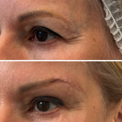 Opadnięcie bocznej części brwi po agresywnej plastyce powiek górnych wykonanej w innym ośrodku- direct brow lift korygujący