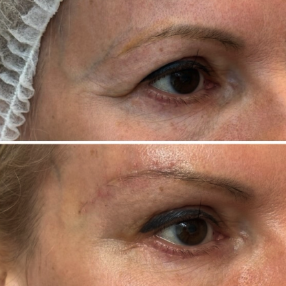 Opadnięcie bocznej części brwi po agresywnej plastyce powiek górnych wykonanej w innym ośrodku- direct brow lift korygujący
