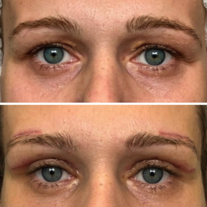 Plastyka powiek górnych z liftem bezpośrednim brwi oraz usunięciem kępek żółtych