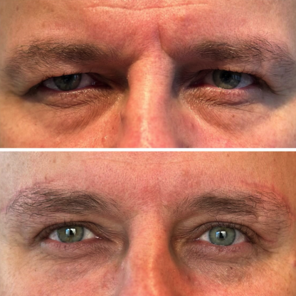 Plastyka powiek górnych z jedoczasowym liftem bezpośrednim brwi