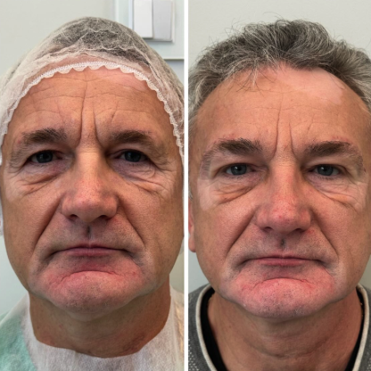 Lift bezpośredni bocznej części brwi, efekt znacznego odmłodzenia twarzy (plastyka powiek zaplanowana w terminie późniejszym)