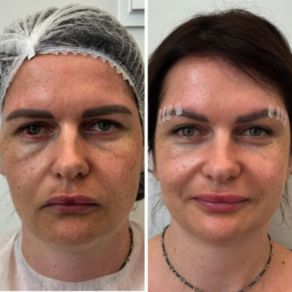Direct brow lift uzupełniający po plastyce powiek górnych obu oczu