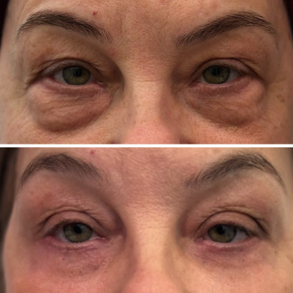 Plastyka powiek dolnych z redukcją przepuklin tłuszczowych wtórnych oraz wcześniejszym liftingiem wolumetrycznym