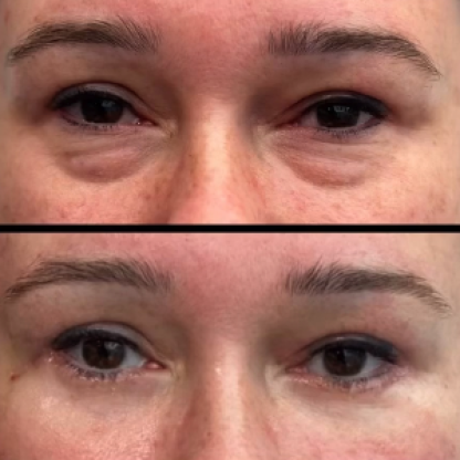 Plastyka powiek dolnych z redukcją przepuklin tłuszczowych