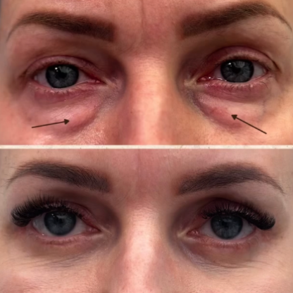 Plastyka powiek dolnych z redukcją przepuklin tłuszczowych i kantopeksją