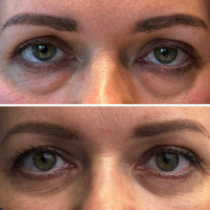 Plastyka powiek dolnych z redukcją przepuklin tłuszczowych