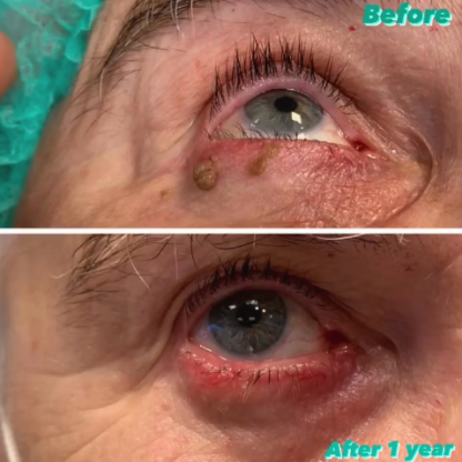 Wycięcie uszypułowanych brodawek łojotokowych powieki dolnej