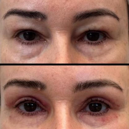Plastyka powiek górnych z redukcją przepuklin tłuszczowych
