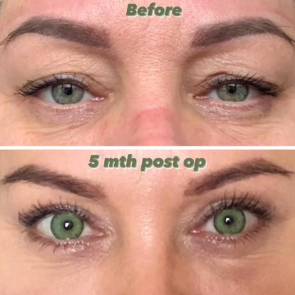 Plastyka powiek górnych z redukcją przepuklin tłuszczowych