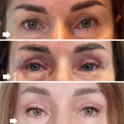 Plastyka powiek górnych z usunięciem zmiany skórnej okolicy podoczodołowej prawej