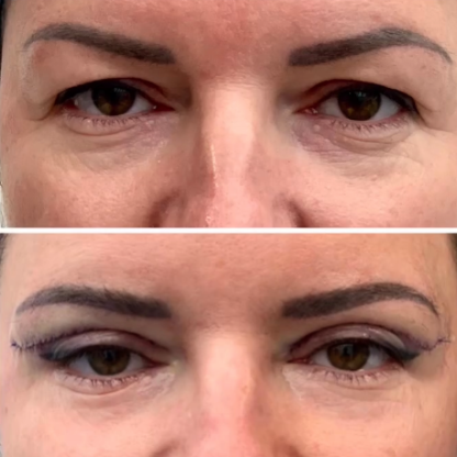 Plastyka powiek górnych z redukcją przepuklin tłuszczowych