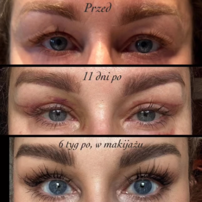 Plastyka powiek górnych przy wyjściowym migdałowym kształcie oczu