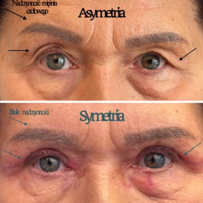 Plastyka powiek górnych z wyrównaniem asymetrii