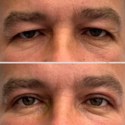Plastyka powiek górnych przy nisko osadzonych brwiach