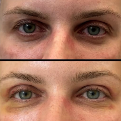 Plastyka powiek górnych z zabezpieczeniem przemieszczania do boku centralnej poduszki tłuszczowej