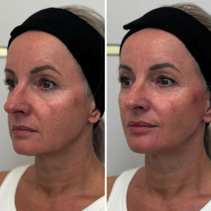 Lifting wolumetryczny