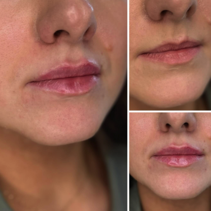 Modelowanie ust  preparatem usieciowanego kwasu hialuronowego