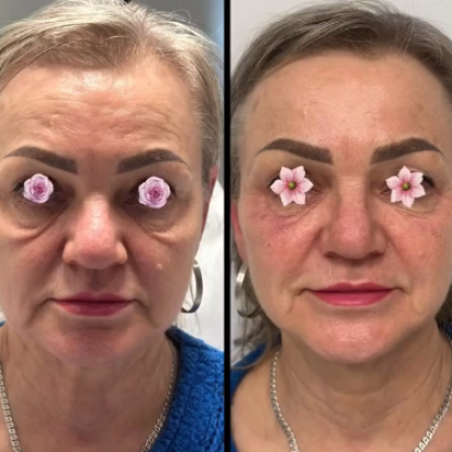 Lifting wolumetryczny