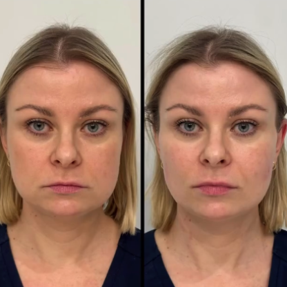 Lifting wolumetryczny