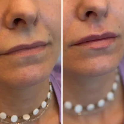 Modelowanie ust  preparatem usieciowanego kwasu hialuronowego