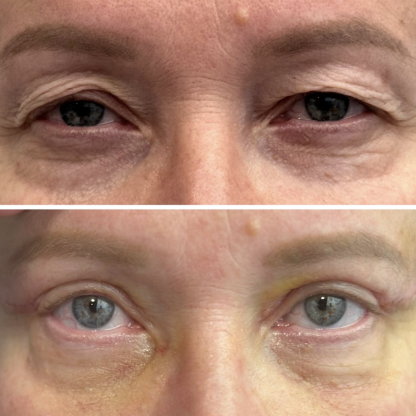 Plastyka powiek górnych z wyrównaniem asymetrii