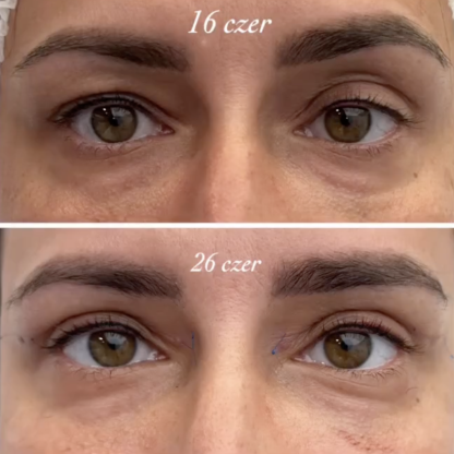 Plastyka powiek górnych z wyrównaniem asymetrii