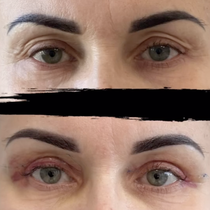 Plastyka powiek górnych z transpozycją tłuszczu.