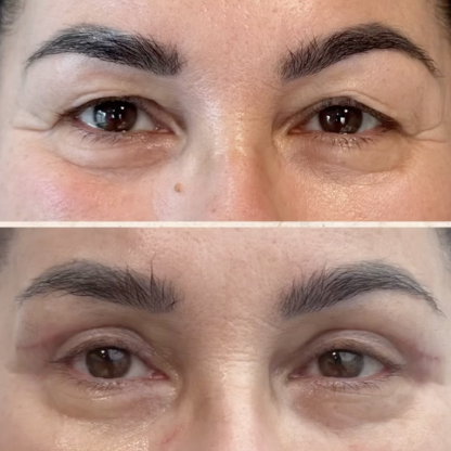 Plastyka powiek górnych z redukcją przepuklin tłuszczowych.