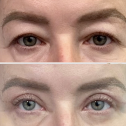 Plastyka powiek górnych obu oczu z redukcją przepuklin tłuszczowych.