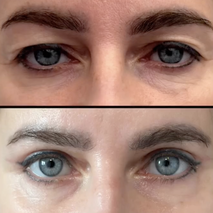 Plastyka powiek górnych przy nisko osadzonych łukach brwiowych