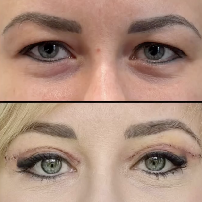 Plastyka powiek górnych z redukcją przepuklin tłuszczowych