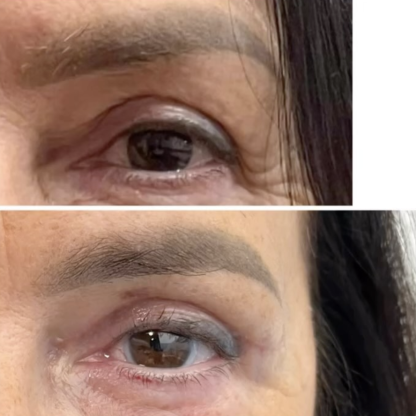 Reoperacja plastyki powiek górnych wykonanej w innym ośrodku