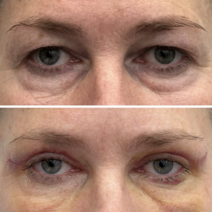 Plastyka powiek górnych obu oczu