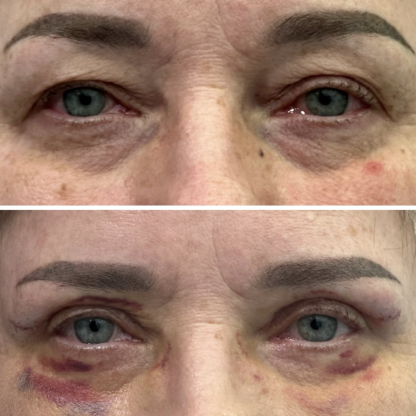 Plastyka powiek górnych obu oczu z redukcją przepuklin tłuszczowych