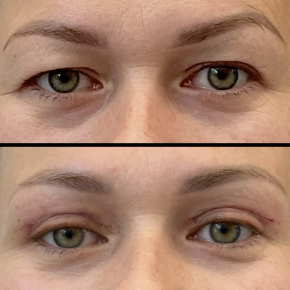 Plastyka powiek górnych obu oczu z redukcją przepuklin tłuszczowych i wyrównaniem asymetrii