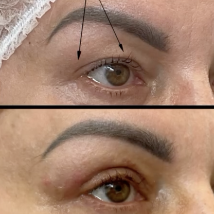 Plastyka powiek górnych obu oczu z podszyciem kąta bocznego.