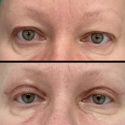 Plastyka powiek górnych z wyrównaniem asymetrii