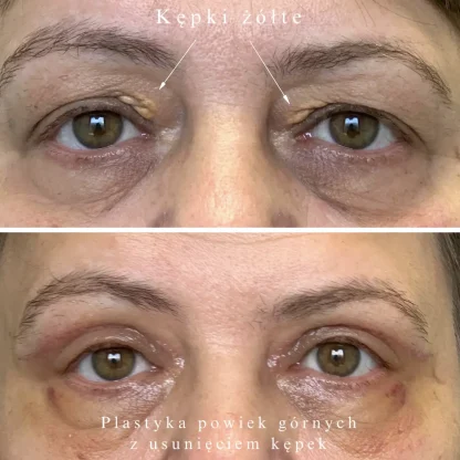 Plastyka powiek górnych z redukcją kępek żółtych obu oczu